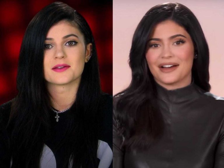 Kylie Jenner Plastic Surgery Before and After Images
