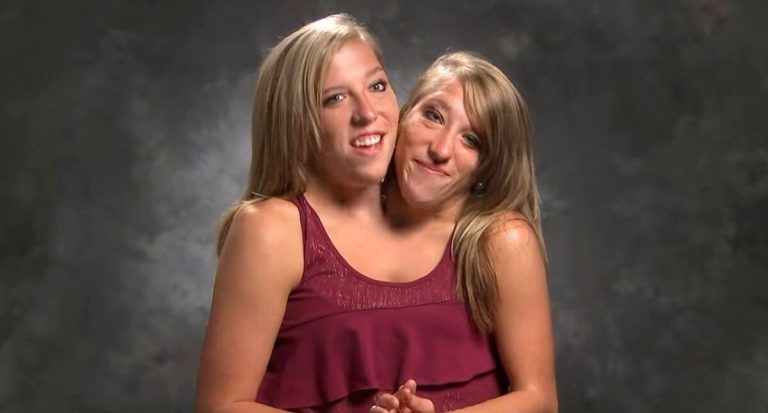 Where are Conjoined Twins Abby and Brittany Hensel Now?