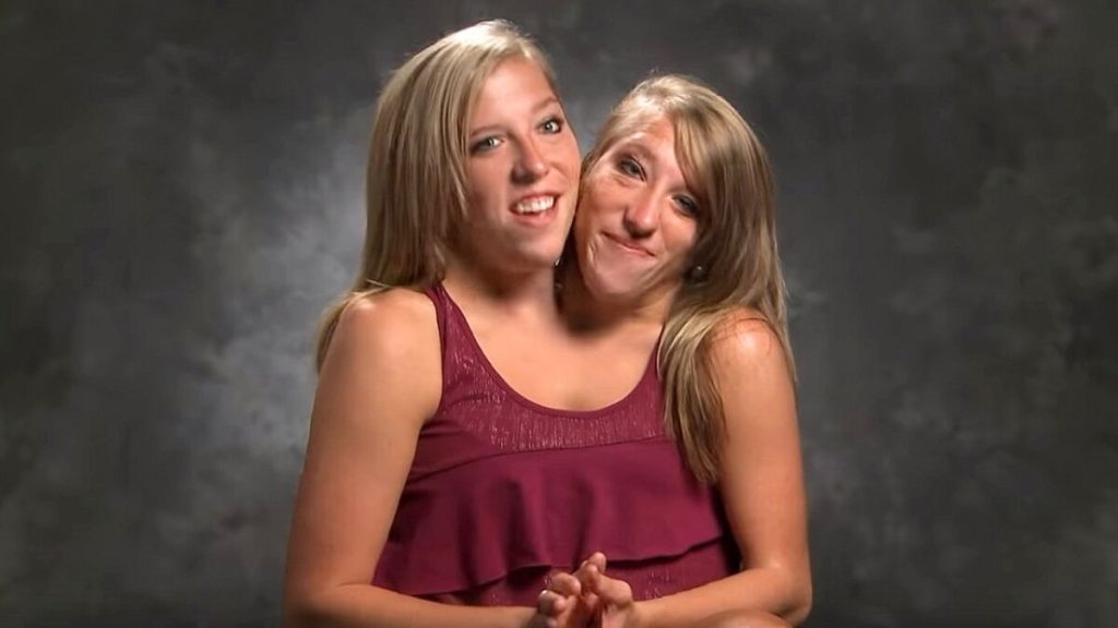 Oases News - Conjoined Twins Abby and Brittany Hensel: Where are they Now?