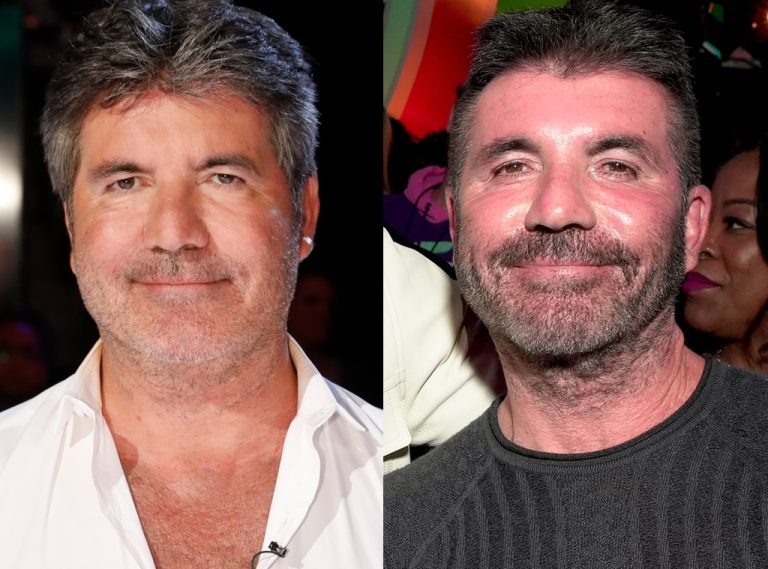 Simon Cowell Plastic Surgery: Before and After Images Explored