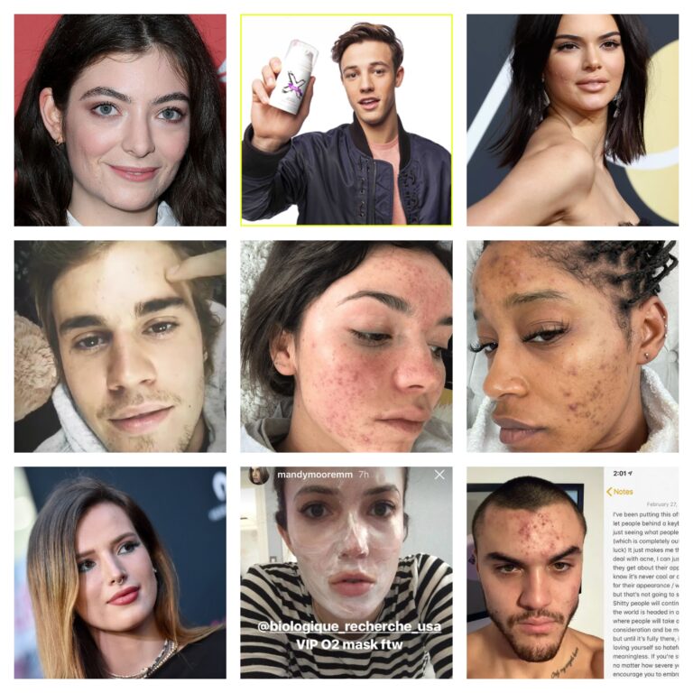 15 Celebrities Who Celebrate Acne Problems, And How They Overcame Them